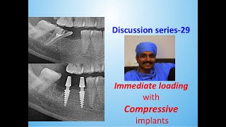 Compressive implants for lower molars replacement  Discussion by Dr Murugavel Best dental clinic [upl. by Nnaynaffit300]