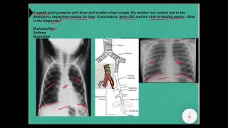 Bronchiolitis [upl. by Uriisa]