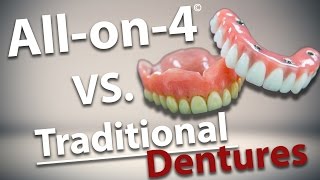 All on 4 Dental Implants VS Traditional Dentures [upl. by Haisi550]