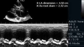 LARGE PERICARDIAL EFFUSION  ECHOCARDIOGRAPHY SERIES BY DRANKURKCHAUDHARI [upl. by Aramo]