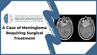 A Case of Meningioma Requiring Surgical Treatment [upl. by Andreas]