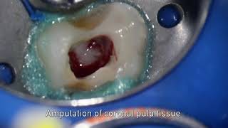 MTA pulpotomy – Video abstract ID 134315 [upl. by Caroline]