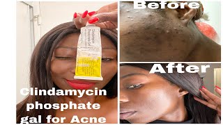 MY ACNE JOURNEY WITH USING CLINDAMYCIN TRETINOIN ACNE IAMSKINBEAUTY [upl. by Lenroc]