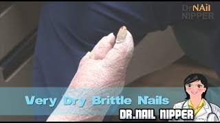 Very Dry Brittle Nails [upl. by Hebert]