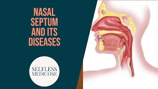 NASAL SEPTUM and DISEASES part 5 septal abscess [upl. by Dott140]