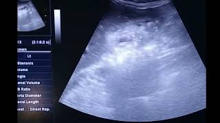 Gallbladder adenomyomatosis on Ultrasound diffuse type [upl. by Amitak]