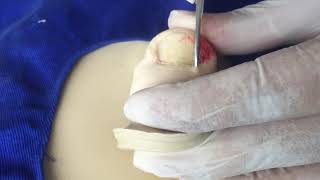 Aula 06  Cantoplastia unha encravada  ingrown nail [upl. by Cottle864]