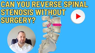 Can you reverse spinal stenosis without surgery [upl. by Russel]