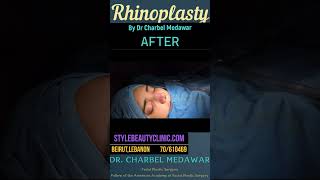 Dr Charbel Medawar Best Rhinoplasty in Lebanon lebanon drcharbelmedawar shorts beautiful viral [upl. by Virgilio781]