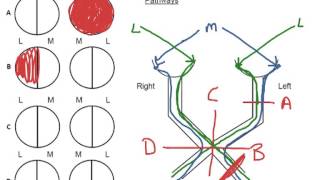 How to Biology amp Anatomy Optic pathways visual fields and the lesions [upl. by Etnohc]