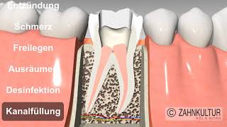Wie läuft eine Wurzelkanalbehandlung ab  Wurzelbehandlung beim Zahnarzt [upl. by Dao]