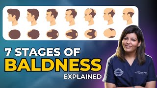 Understanding Hair Loss Stages A Comprehensive Guide to Scalp Assessment and Treatment Options [upl. by Eirek113]