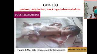 Case 189 hypokalemic metabolic alkalosis Bartter syndrome hyperprostaglandin Syndrome hypercalciu [upl. by Samford273]