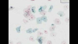 Histopathology CervixLow grade squamous intraepithelial le [upl. by Loredana944]