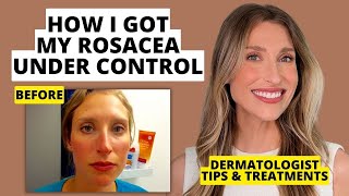 My Rosacea Journey Dermatologist Shares Skincare amp Treatments That Work  Dr Sam Ellis [upl. by Tteraj266]