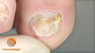 Thickened toenails  Thoroughly clearing the lateral and distal edge of the nails  Podology [upl. by Assenay]