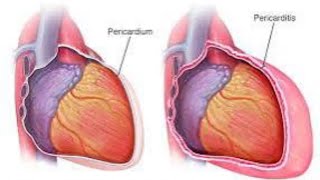 شرح pericarditis 🔥💓💯💫 [upl. by Harret]