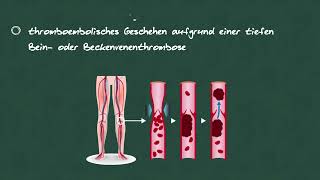 Notaufnahme  Die Lungenarterienembolie [upl. by Jaquelyn]