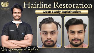 Transformative Hairline Restoration Case Study ✅Hair Transplant Before After Results  Medlinks [upl. by Hunt]