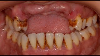 Tooth Loss due to Periodontal Gum Disease [upl. by Lemej]