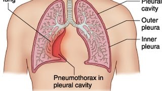 Pneumothorax [upl. by Hunsinger]