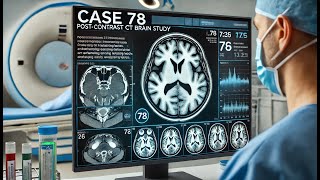 Case 78 postcontrast CT brain study [upl. by Nosrettap]