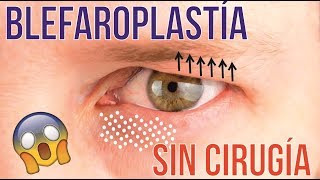 BLEFAROPLASTÍA SIN CIRUGÍA MEDIANTE LASER CO2 FRACCIONADO 💕 DR ALBERTO CALVO QUIROZ [upl. by Virendra]