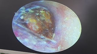 Cerumen embolism cleaning earwax Cleaning earwaxremoval satisfying [upl. by Ovida963]