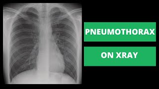 Chest X Ray Interpretation Explained Clearly  How to read a chest Xray [upl. by Damalus]