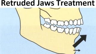 The Orthodontic Treatment of Retruded Backward Jaws Mandible with Tooth Extraction by Dr Mike Mew [upl. by Nisse]