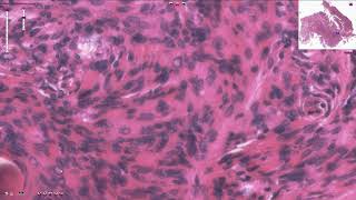 Meningioma  Histopathology [upl. by Nnaarual]