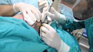 Ablatie cu laser CO2 tumoreta scalp Dr Jianu ProEstetica [upl. by Carbone]