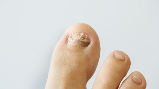 How to prevent and treat nail fungus [upl. by Naghem]