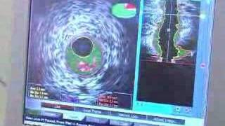 IVUS Vascular Imaging [upl. by Tarrance]