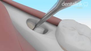 Exodoncia COMPLEJA tercer molar incluido  Video 3D paso a paso [upl. by Atteyek]