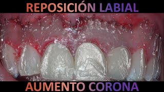 Reposición labial  gingivectomía y gingivoplastía cirugiaperiodontal periodoncia lipreposition [upl. by February]