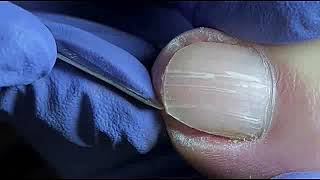 DIY Ingrown Toenail Removal  How to Safely Cut Ingrown Toenails at Home [upl. by Clinton416]