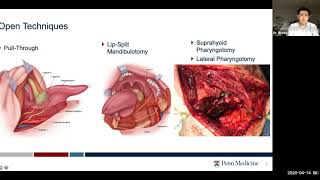 Surgical Treatment of Oropharyngeal Cancer  Dr Robert Brody [upl. by Penoyer833]