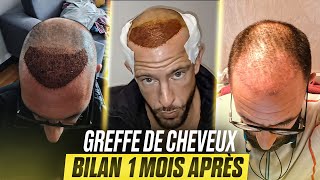 🟢J30 Greffe de Cheveux  1 Mois APRÈS mes Implants capillaire en Turquie🇹🇷 avec la Clinique Klineva [upl. by Dehnel]