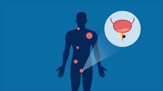 Abiraterone Acetate Plus Prednisone in Prostate Cancer [upl. by Einre]