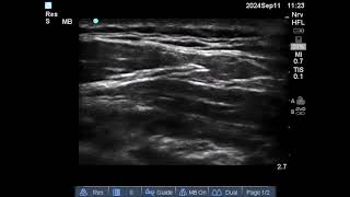 Costoclavicular block 11 sept 24 [upl. by Delainey]