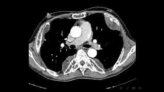 Chest X ray interpretation part 4DR AMR SAADAWY [upl. by Neelik]