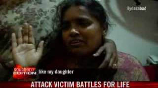 Girl burnt in acid attack fights for life [upl. by Dlonyer]