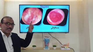 Granular myringitis Hindi Patient teaching programme [upl. by Peggir]