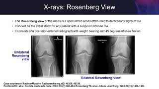 Knee Osteoarthritis Examining the Evidence on SingleInjection Hyaluronic Acid [upl. by Burn]