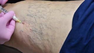 Allure Vein Center Sclerotherapy Spider Vein Treatment [upl. by Trisa]