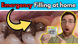 DIY Tooth filling Using Temporary filling material at home [upl. by Marlane]