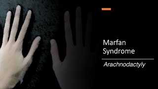 Marfan Syndrome Wrist and Thumb Sign [upl. by Gnivri]