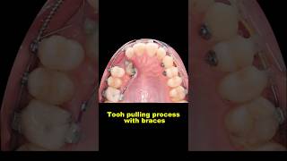 Pulling out hidden teeth when braces braces orthodontist dentist bracesoff [upl. by Araic]