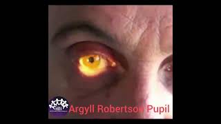 ARGYLL ROBERTSON PUPIL [upl. by Leonid]